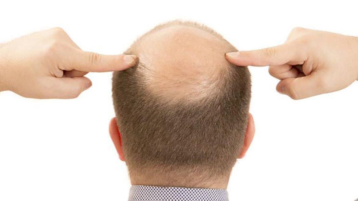 ¿Qué es la Alopecia o Calvicie común?